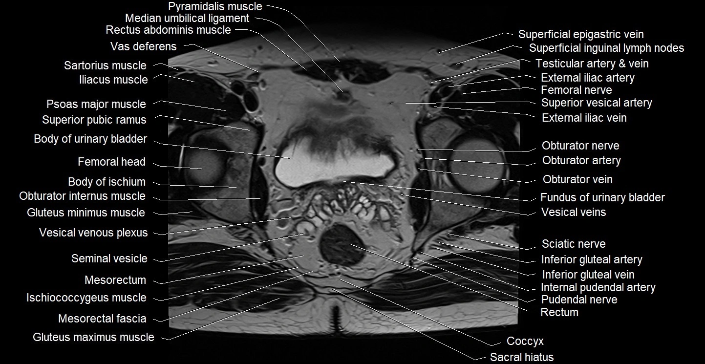 Male pelvis axial cross sectional anatomy image 25.webp